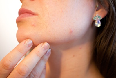 Pickel, Falten und Hautirritationen: Rechtzeitig vorbeugen für eine gesunde und straffe Haut