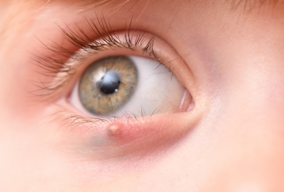Gerstenkorn: Ursachen und Behandlung der gelbfarbenen Bläschen am Auge
